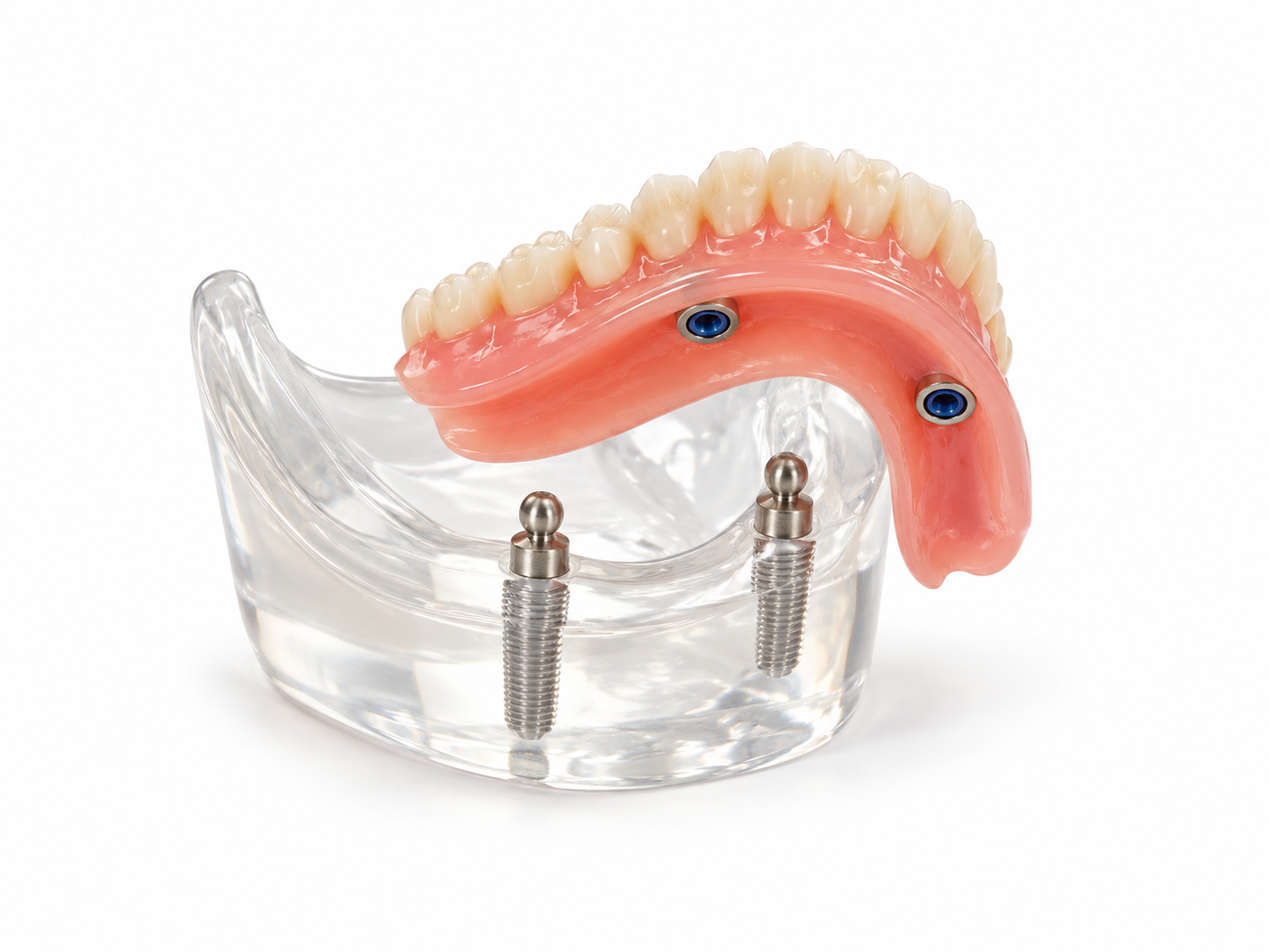 Implant-retained denture illustration